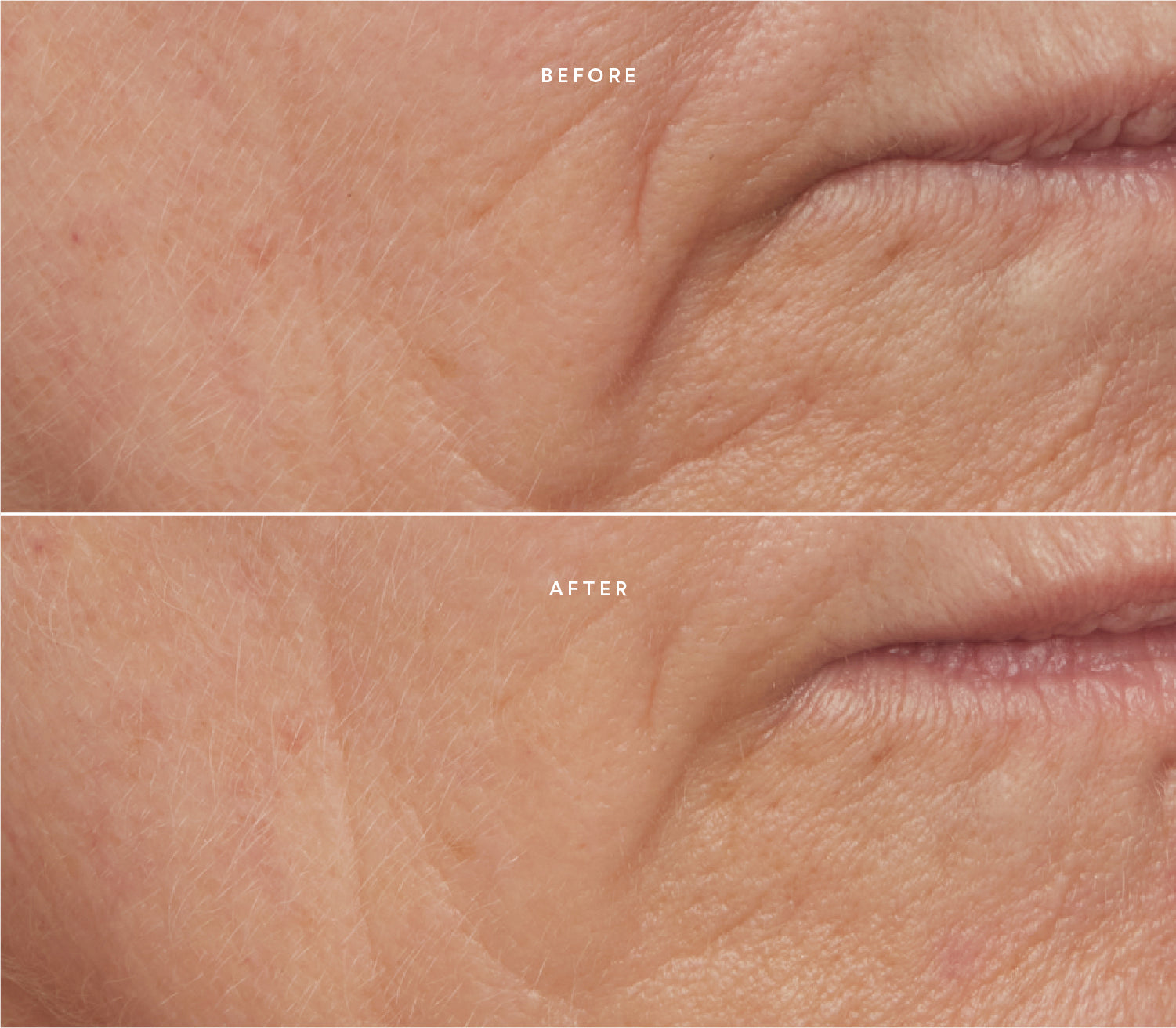 Before and after comparison showing smoother skin texture and reduced fine lines around the mouth area.