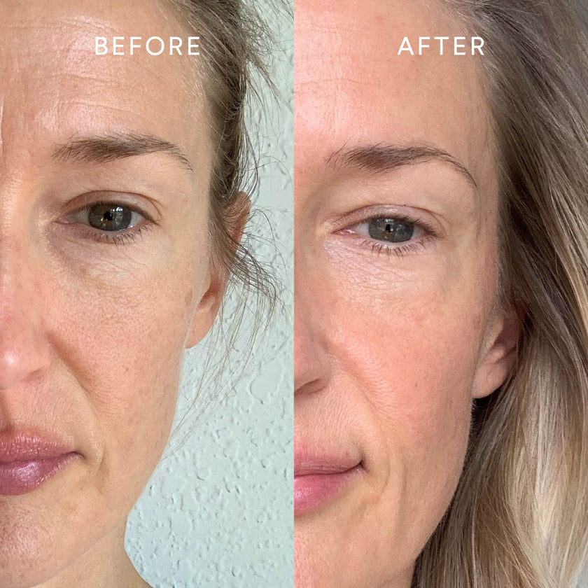 before and after of face with less wrinkles
