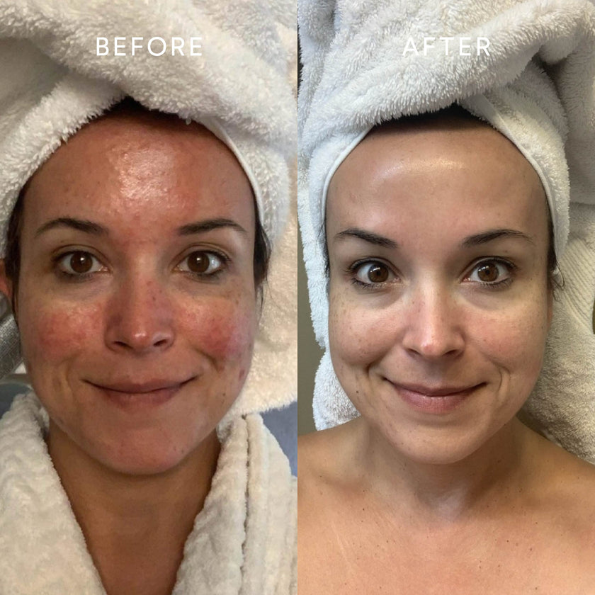 Before and after comparison showing reduced breakouts and a calmer, more even skin tone.