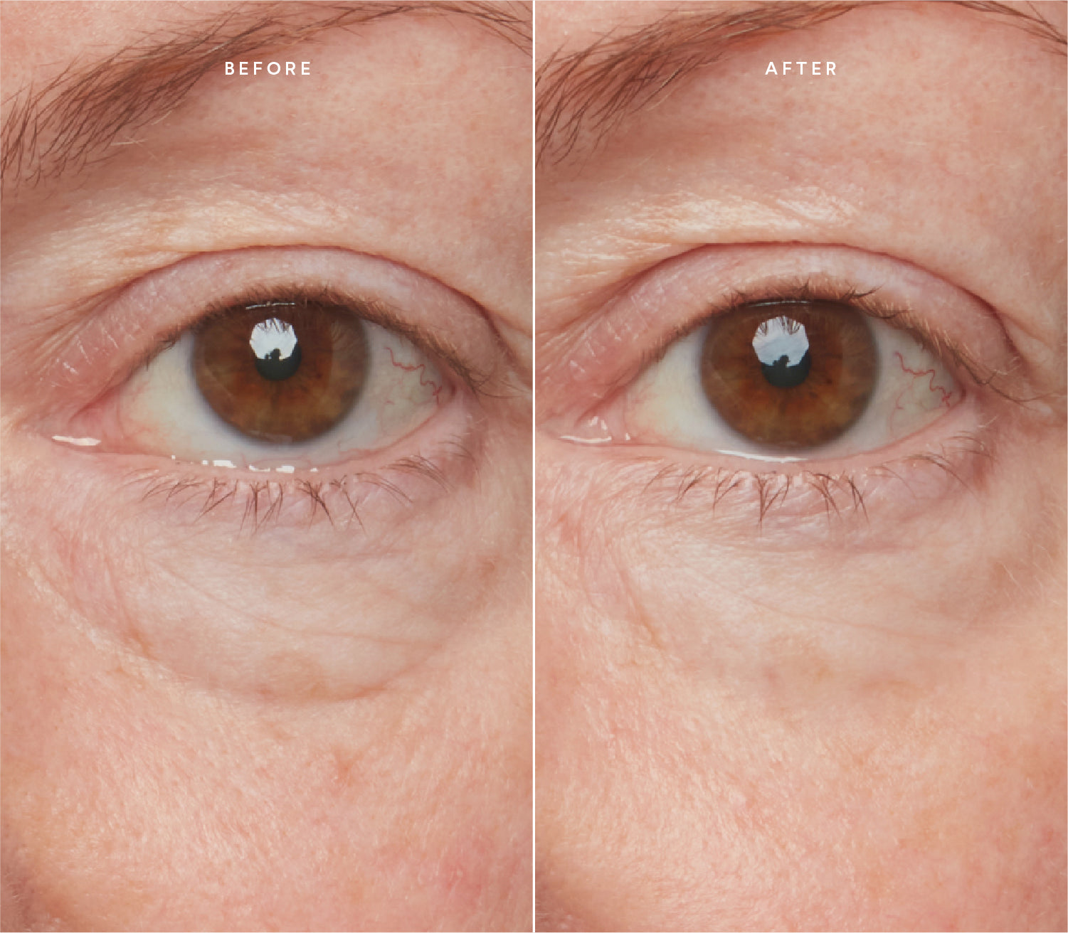 Before and after comparison showing smoother skin texture and reduced fine lines around the eye area.