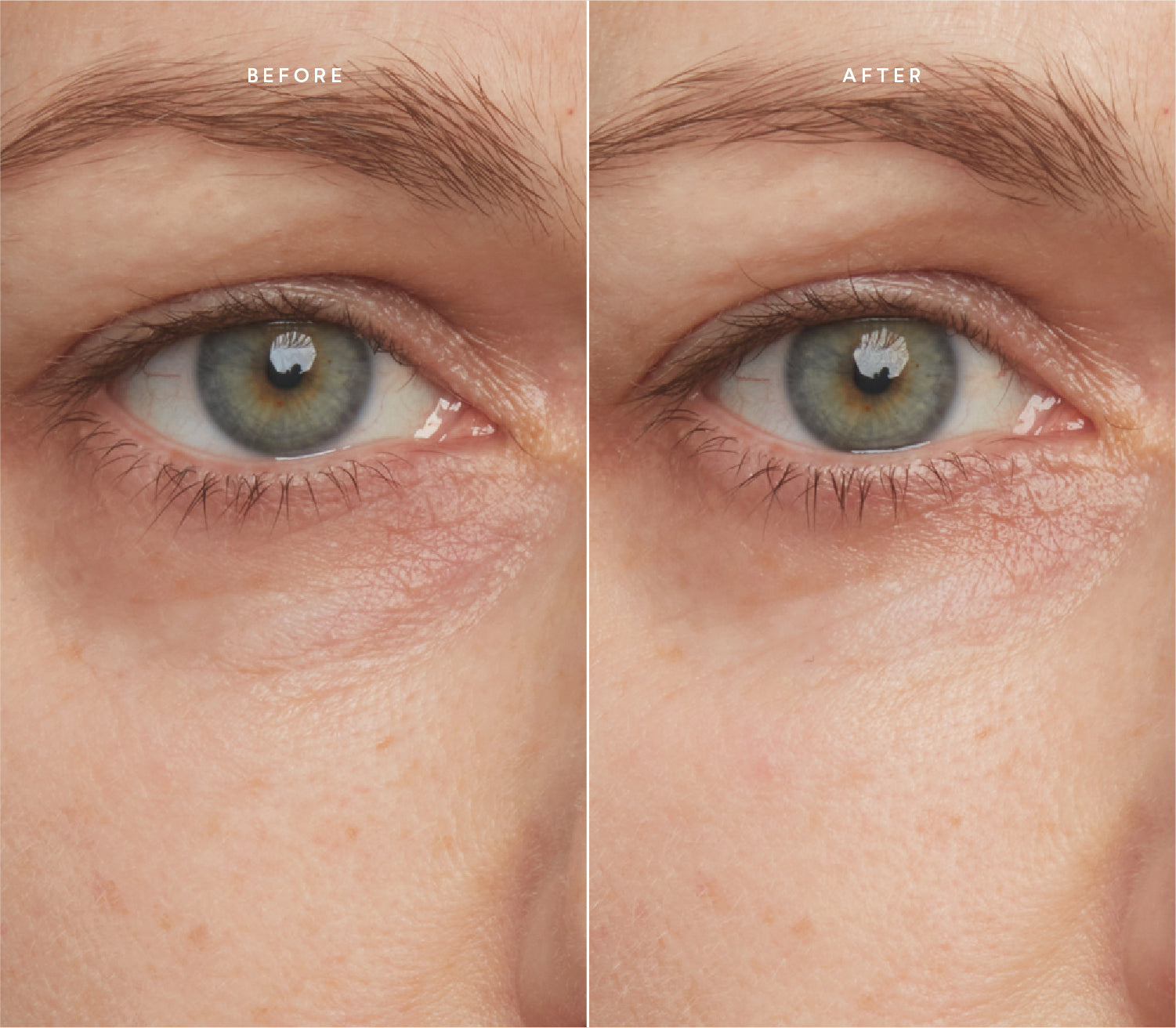 Before and after comparison showing smoother skin texture and reduced fine lines around the eye area.
