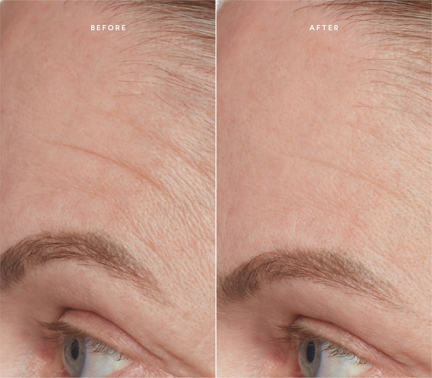 Before and after comparison showing smoother skin texture and reduced fine lines around the forehead.