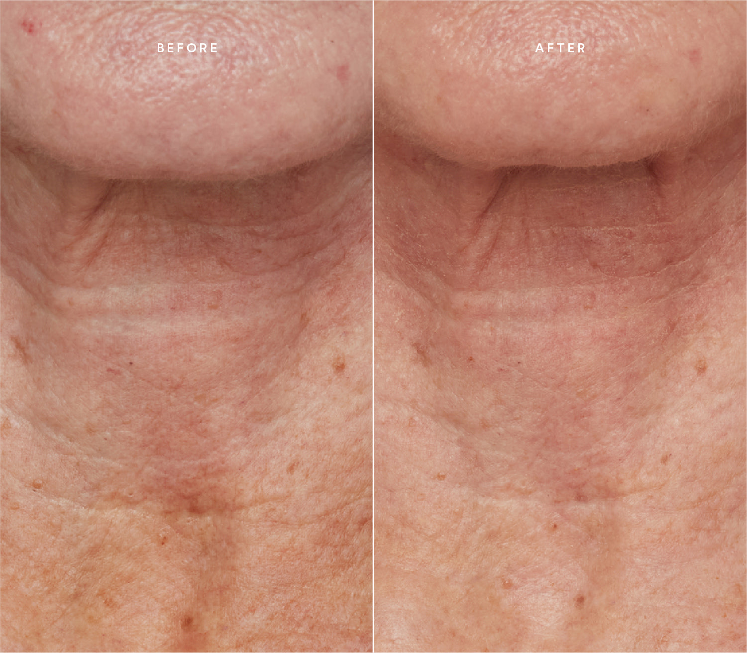 Before and after comparison showing improved skin texture and reduced wrinkles on the neck.