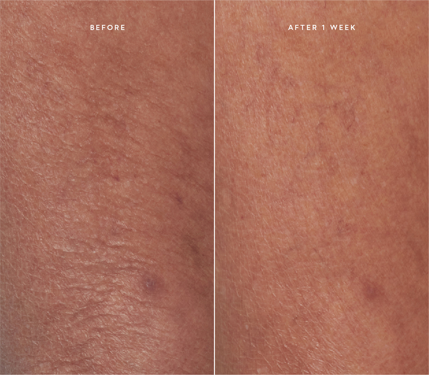 Before and after comparison showing improved skin texture.
